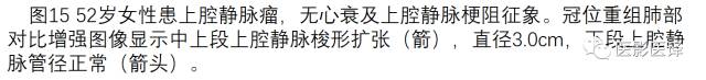 上腔静脉全面影像学回顾 上腔静脉全面影像学回顾