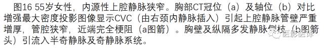 上腔静脉全面影像学回顾 上腔静脉全面影像学回顾