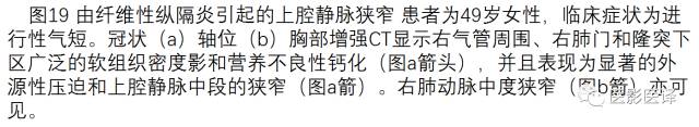 上腔静脉全面影像学回顾 上腔静脉全面影像学回顾