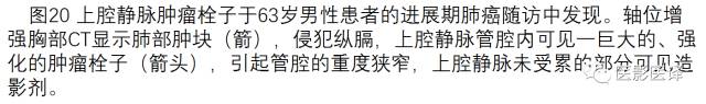 上腔静脉全面影像学回顾 上腔静脉全面影像学回顾
