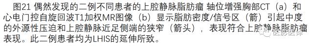 上腔静脉全面影像学回顾 上腔静脉全面影像学回顾