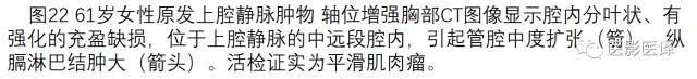 上腔静脉全面影像学回顾 上腔静脉全面影像学回顾