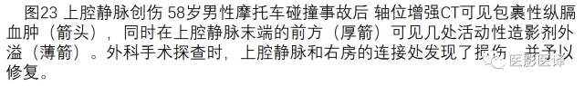 上腔静脉全面影像学回顾 上腔静脉全面影像学回顾