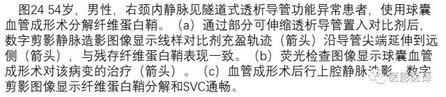 上腔静脉全面影像学回顾 上腔静脉全面影像学回顾