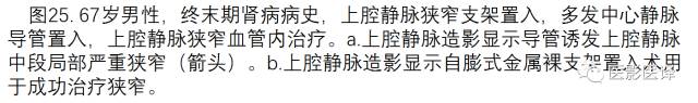 上腔静脉全面影像学回顾 上腔静脉全面影像学回顾