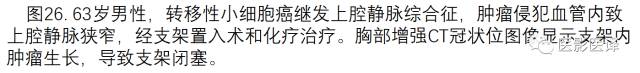 上腔静脉全面影像学回顾 上腔静脉全面影像学回顾