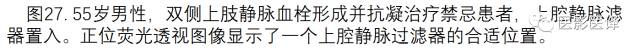 上腔静脉全面影像学回顾 上腔静脉全面影像学回顾