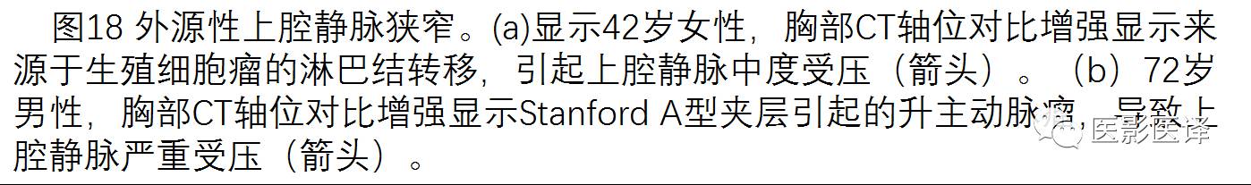 上腔静脉全面影像学回顾 上腔静脉全面影像学回顾