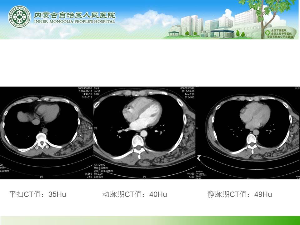 【病例】背部血管脂肪瘤1例CT