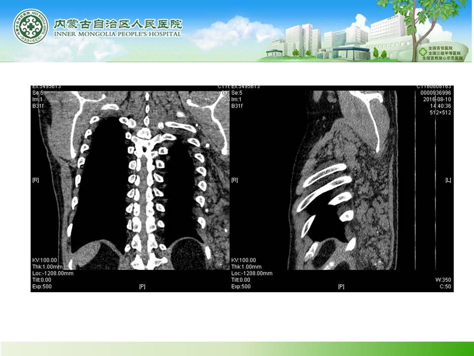 【病例】背部血管脂肪瘤1例CT