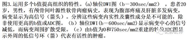 DWI原理及应用:癌症检测、分级和治疗随访 DWI原理及应用:癌症检测、分级和治疗随访