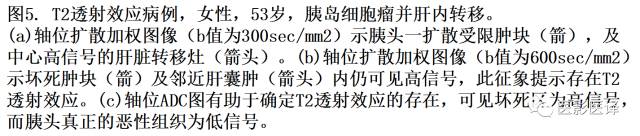 DWI原理及应用:癌症检测、分级和治疗随访 DWI原理及应用:癌症检测、分级和治疗随访