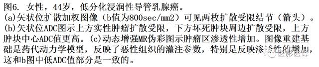 DWI原理及应用:癌症检测、分级和治疗随访 DWI原理及应用:癌症检测、分级和治疗随访