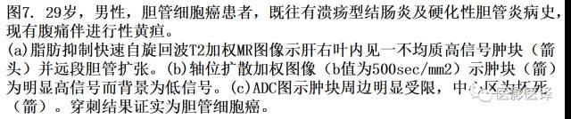 DWI原理及应用:癌症检测、分级和治疗随访 DWI原理及应用:癌症检测、分级和治疗随访