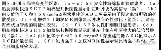 DWI原理及应用:癌症检测、分级和治疗随访 DWI原理及应用:癌症检测、分级和治疗随访