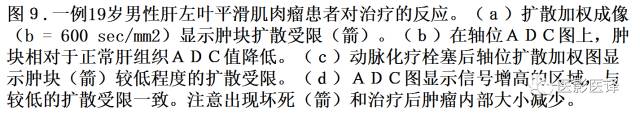 DWI原理及应用:癌症检测、分级和治疗随访 DWI原理及应用:癌症检测、分级和治疗随访