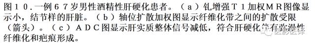 DWI原理及应用:癌症检测、分级和治疗随访 DWI原理及应用:癌症检测、分级和治疗随访