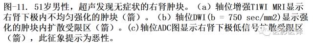 DWI原理及应用:癌症检测、分级和治疗随访 DWI原理及应用:癌症检测、分级和治疗随访