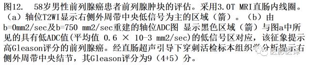 DWI原理及应用:癌症检测、分级和治疗随访 DWI原理及应用:癌症检测、分级和治疗随访