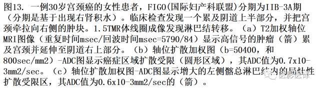 DWI原理及应用:癌症检测、分级和治疗随访 DWI原理及应用:癌症检测、分级和治疗随访