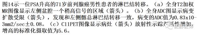 DWI原理及应用:癌症检测、分级和治疗随访 DWI原理及应用:癌症检测、分级和治疗随访