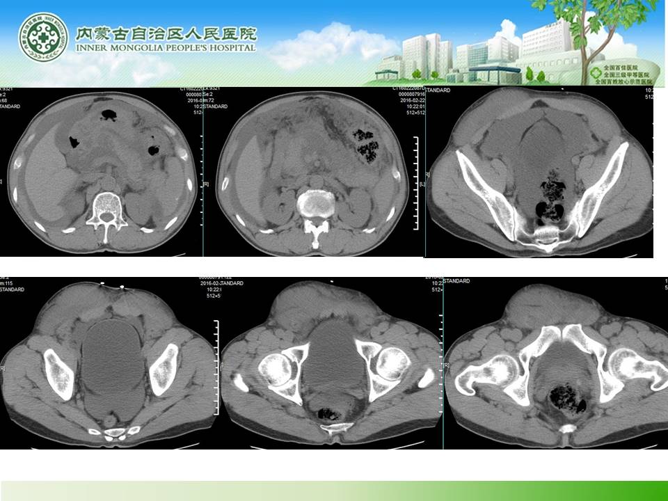 【病例】腹壁腹膜间皮瘤1例CT
