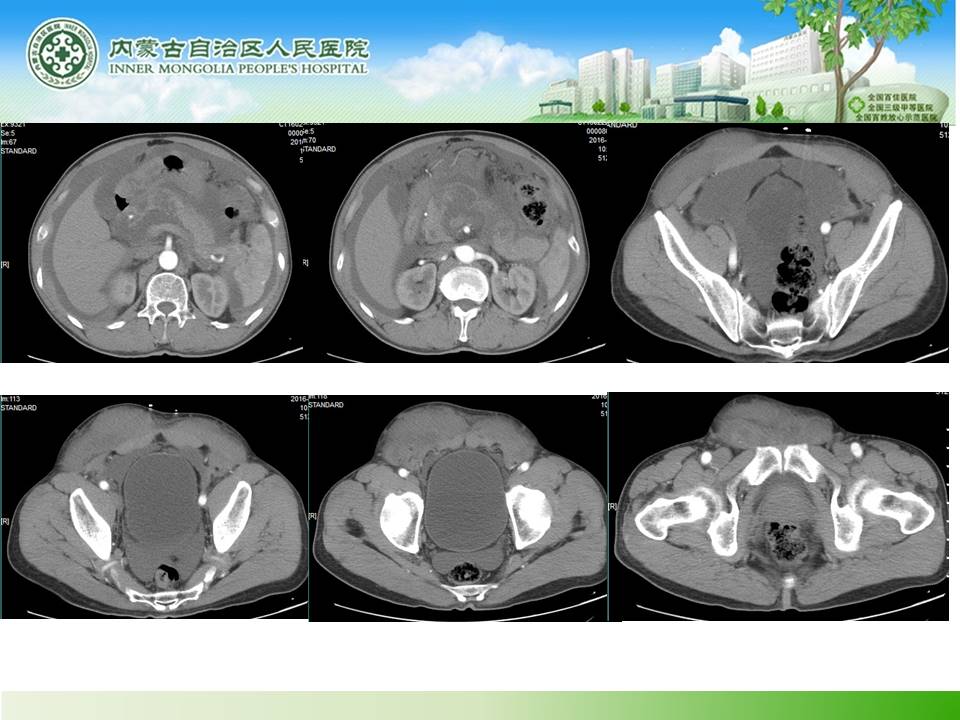 【病例】腹壁腹膜间皮瘤1例CT