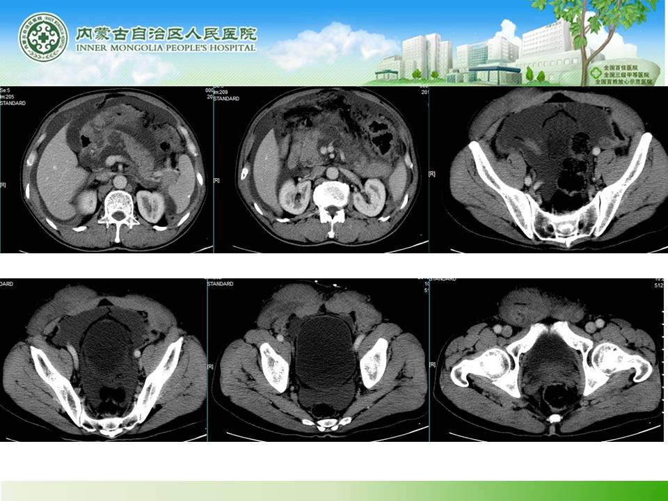 【病例】腹壁腹膜间皮瘤1例CT