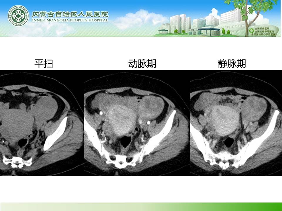 【病例】子宫内膜癌卵巢转移1例CT