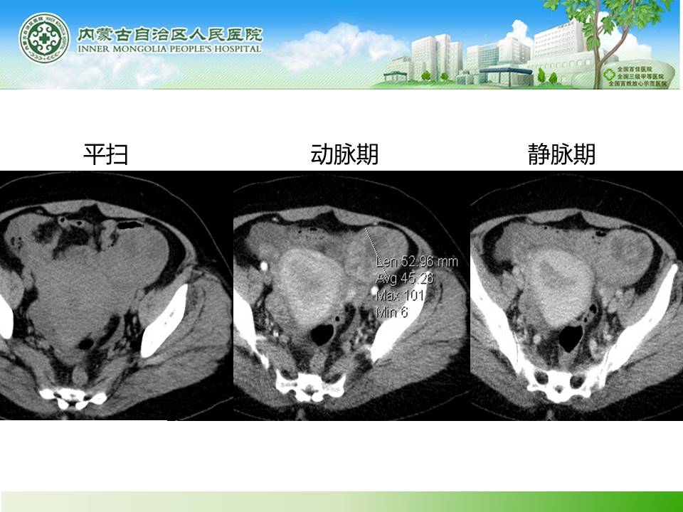 【病例】子宫内膜癌卵巢转移1例CT