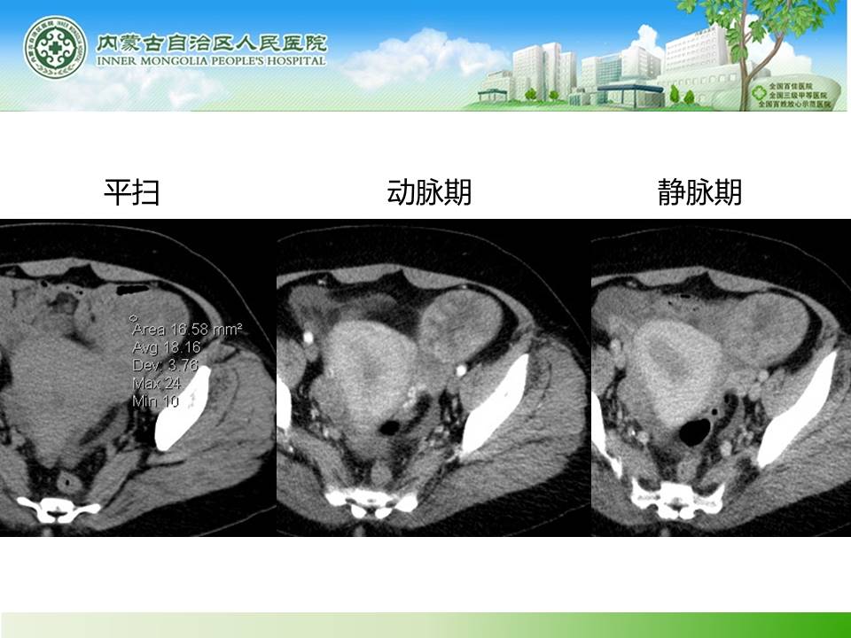 【病例】子宫内膜癌卵巢转移1例CT