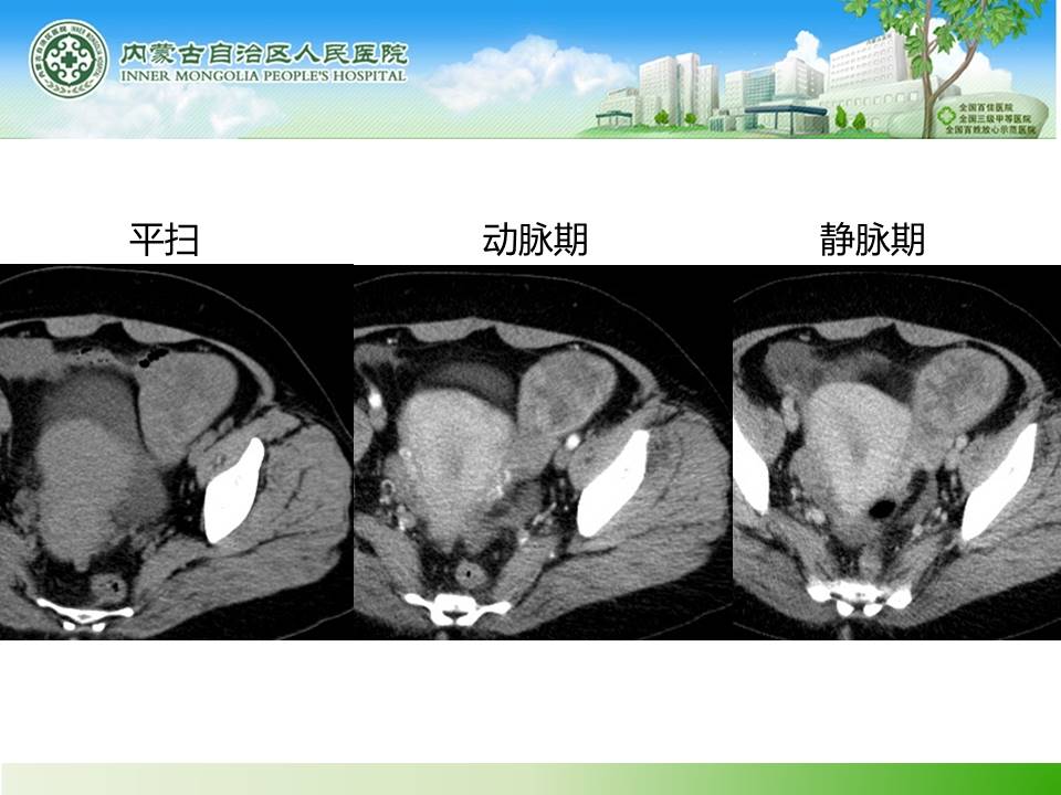 【病例】子宫内膜癌卵巢转移1例CT