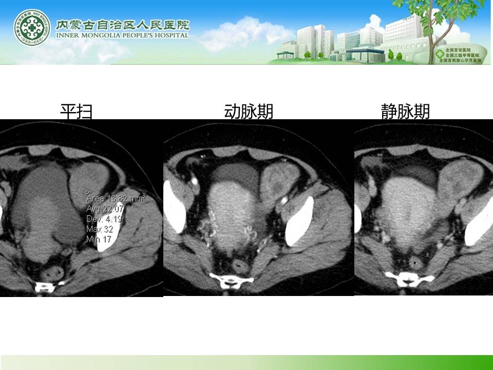 【病例】子宫内膜癌卵巢转移1例CT