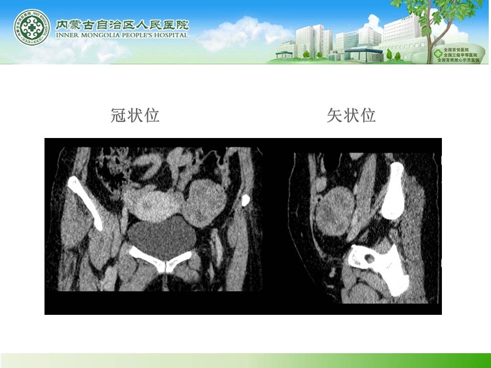【病例】子宫内膜癌卵巢转移1例CT