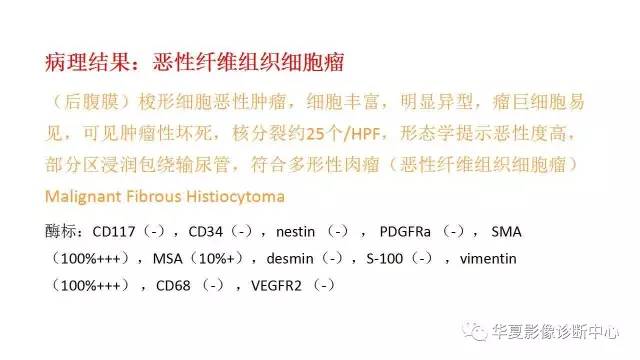 【病例】腹膜后恶性纤维组织细胞瘤1例CT影像表现
