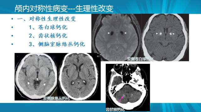 【PPT】颅内对称性病变汇总