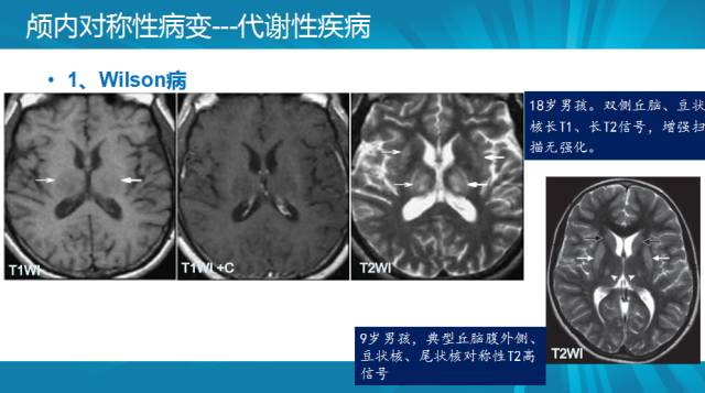 【PPT】颅内对称性病变汇总