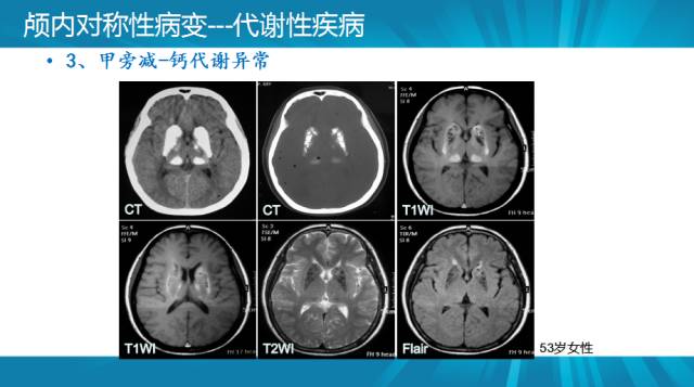 【PPT】颅内对称性病变汇总