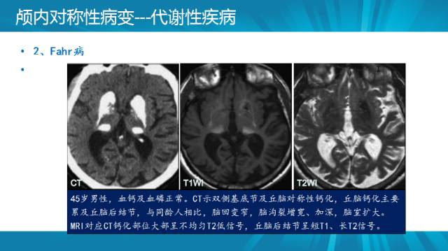 【PPT】颅内对称性病变汇总