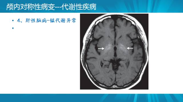 【PPT】颅内对称性病变汇总