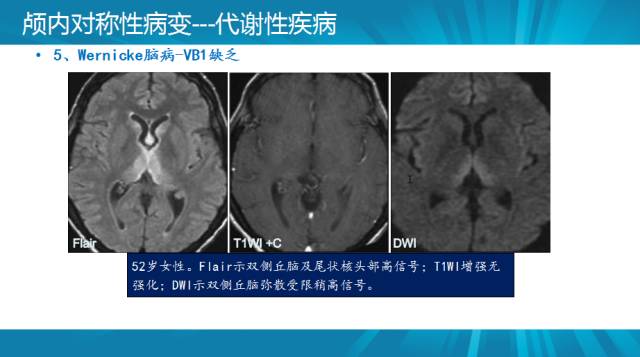 【PPT】颅内对称性病变汇总
