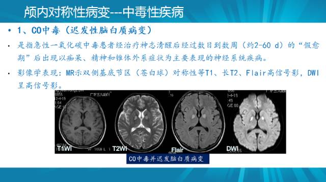 【PPT】颅内对称性病变汇总