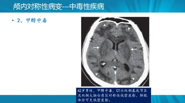 【PPT】颅内对称性病变汇总