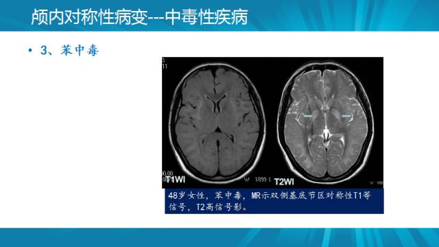 【PPT】颅内对称性病变汇总