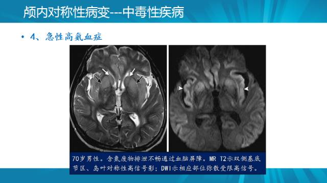 【PPT】颅内对称性病变汇总