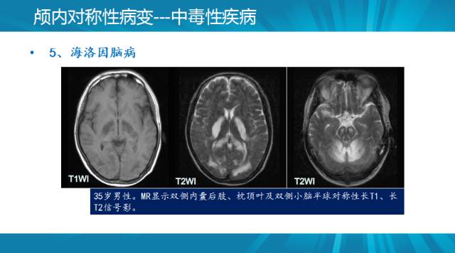 【PPT】颅内对称性病变汇总