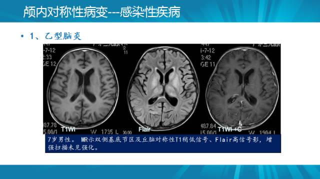 【PPT】颅内对称性病变汇总