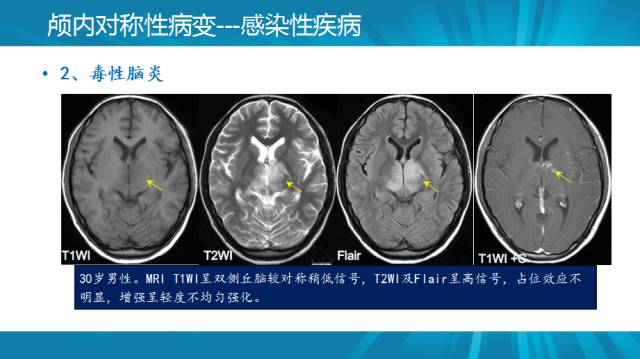 【PPT】颅内对称性病变汇总