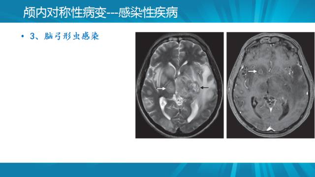 【PPT】颅内对称性病变汇总