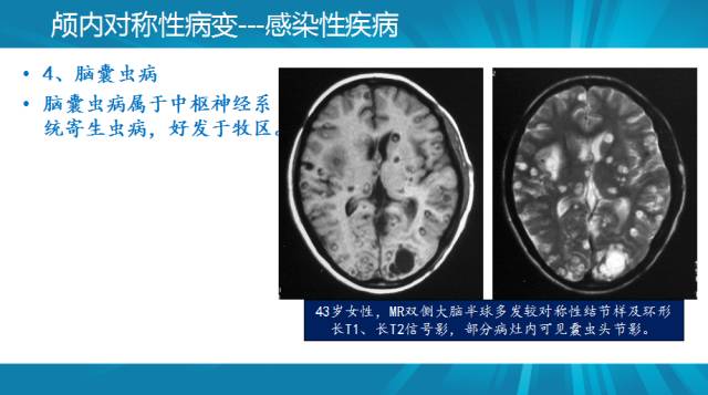 【PPT】颅内对称性病变汇总